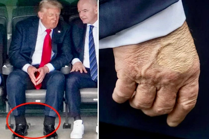 Что случилось с руками Трампа: объяснение Белого дома