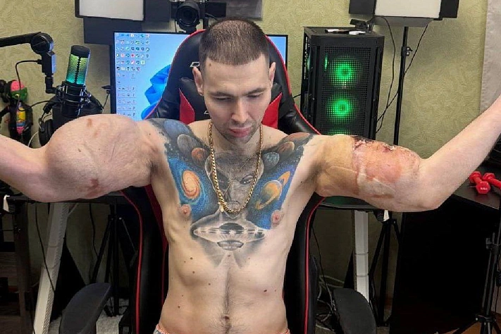 Блогеру «Руки-Базуки» грозит ампутация из-за последствий инъекций синтола