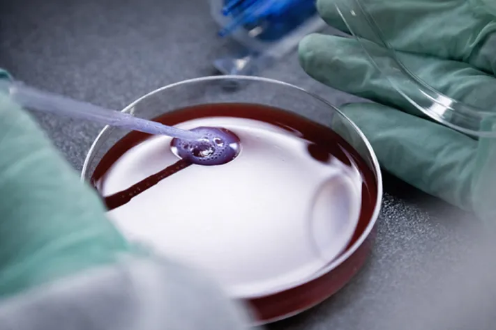 Разработан анализ крови для ранней диагностики рака лёгких