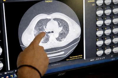 учёные нашли в мозге общий «отпечаток» психоделиков