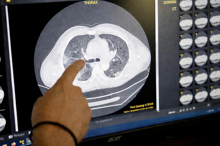 Учёные нашли в мозге общий «отпечаток» психоделиков