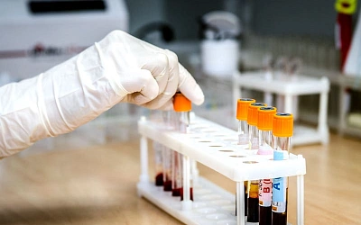 Названа группа крови, носители которой больше рискуют инсультом в молодости