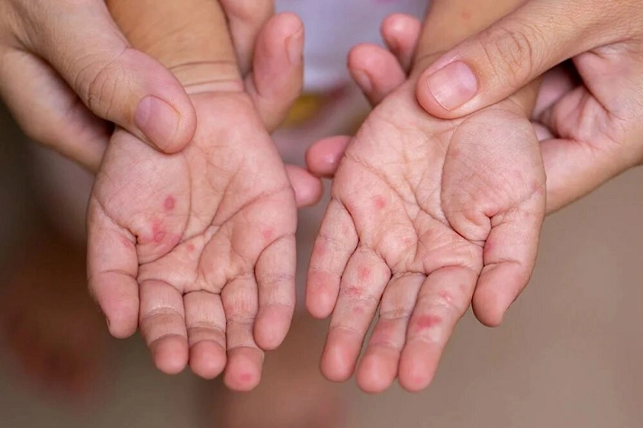 Синдром «рука-нога-рот»: как проявляется и передается вирус Коксаки