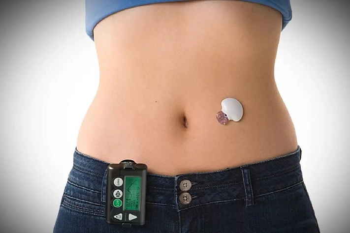 В России разрабатывают отечественную искусственную «поджелудочную железу»