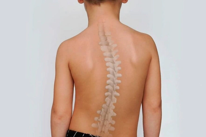 Сколиоз на самом деле не из-за кривой спины за партой