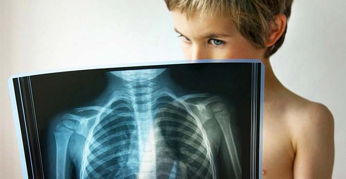 В России выросла заболеваемость туберкулёзом и гепатитом среди детей