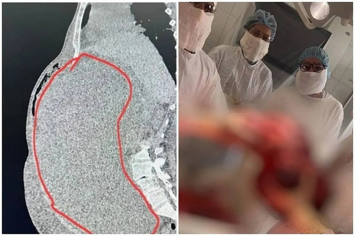 Пожилая пациентка обратилась к врачам с жалобами на лишний вес, но медики нашли опухоль