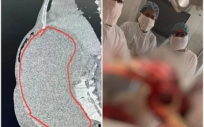 Пожилая пациентка обратилась к врачам с жалобами на лишний вес, но медики нашли опухоль