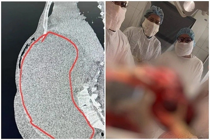 Пожилая пациентка обратилась к врачам с жалобами на лишний вес, но медики нашли опухоль