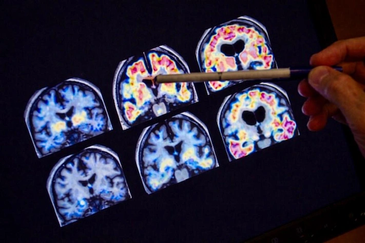 Ученые ищут способ смягчить тяжелые воспоминания при ПТСР