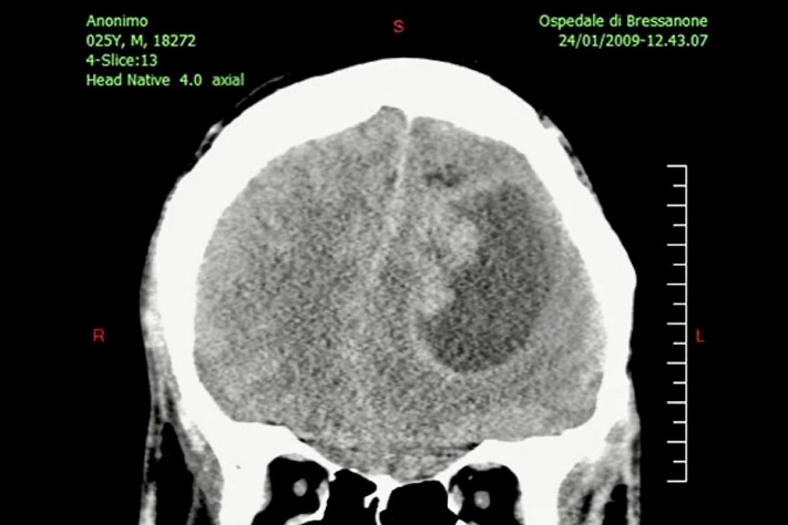 Израильские учёные предлагают новый подход к лечению рака мозга