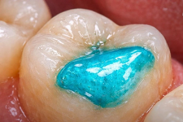 Российские учёные создали технологию восстановления зубной эмали