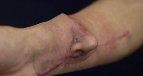 Белорусские хирурги вырастили пациенту нос… на руке