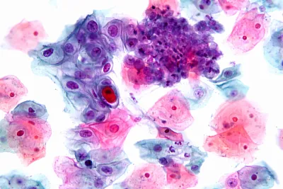 мазок из щеки может упростить диагностику шизофрении