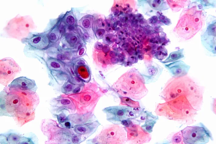 Мазок из щеки может упростить диагностику шизофрении