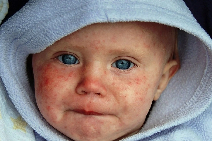 Почему ветрянка возвращается и как защититься от кори