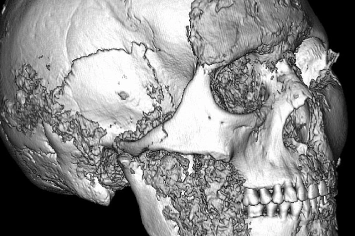 Учёные нашли следы сложной операции у скифской женщины на Алтае