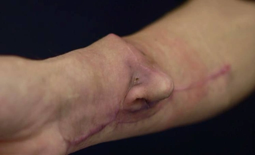 Белорусские хирурги вырастили пациенту нос… на руке